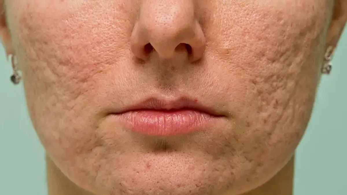 انواع اسکار آکنه (آیس پیک، باکس کار، رولینگ): علل، درمان و پیشگیری