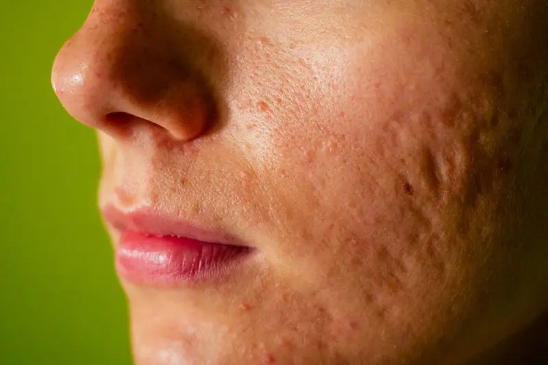 1. اسکار آیس پیک (Ice Pick Scars): سوراخهای عمیق و باریک