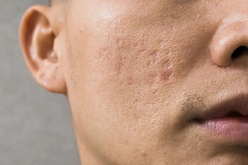 روشهای کلی درمان اسکار آکنه