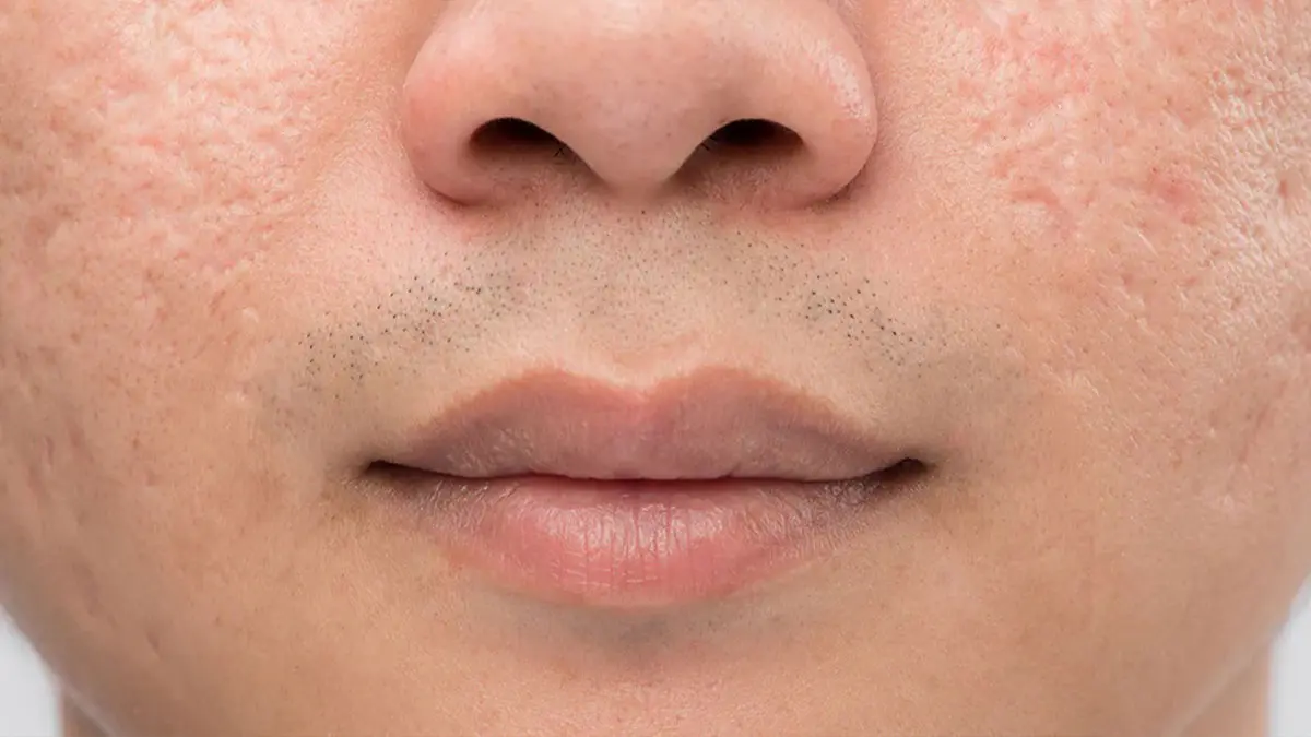 آیا جای جوشهای شما دائمی است؟