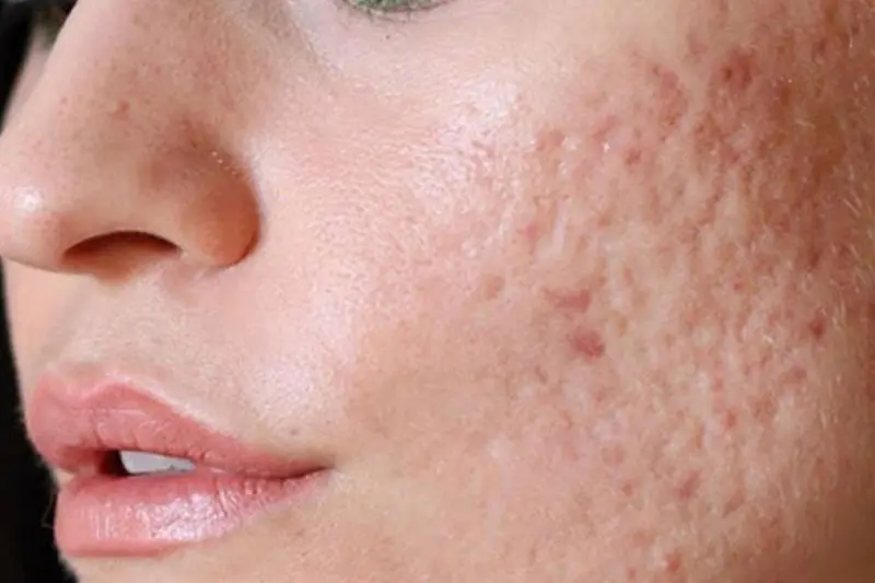 آیا جای جوشهای شما دائمی است؟