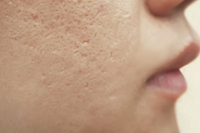 آیا جای جوشهای شما دائمی است؟