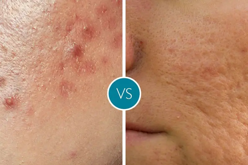 PIH چیست؟ (لکهای رنگی پس از التهاب)