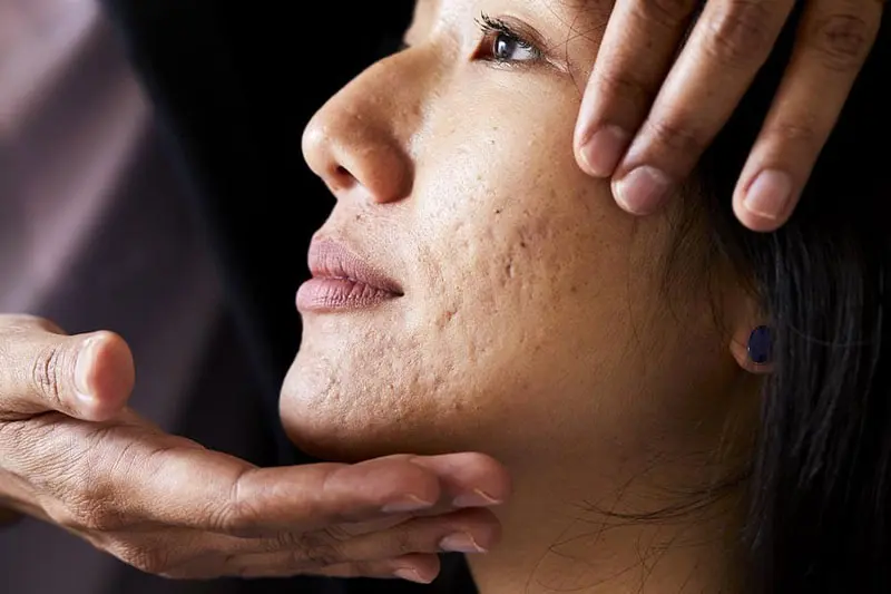 تفاوت اسیدتراپی و رتینول برای درمان اسکار جوش