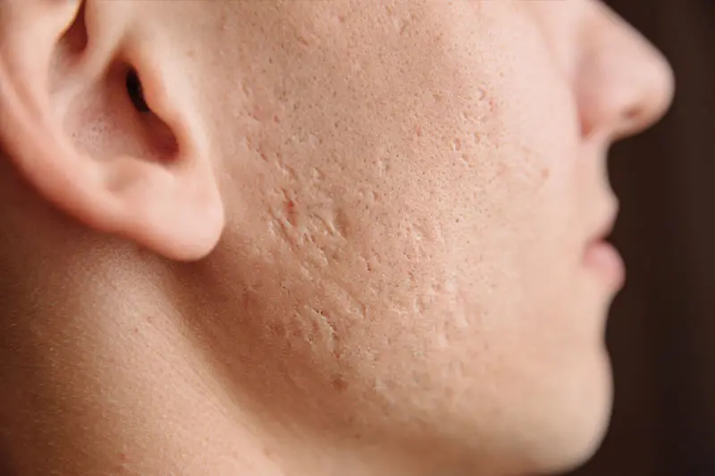 تفاوت اسیدتراپی و رتینول برای درمان اسکار جوش