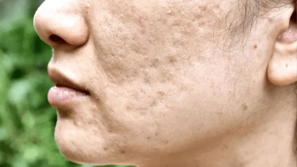 میکرونیدلینگ در مقابل لیزر فرکشنال CO2؛ کدام روش برای اسکار جای جوش بهتر است؟