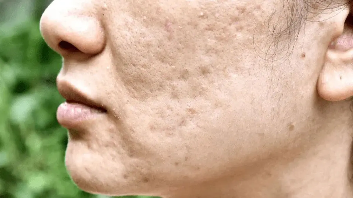 میکرونیدلینگ در مقابل لیزر فرکشنال CO2؛ کدام روش برای اسکار جای جوش بهتر است؟