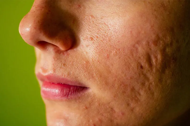 لیزر فرکشنال CO2 چیست؟