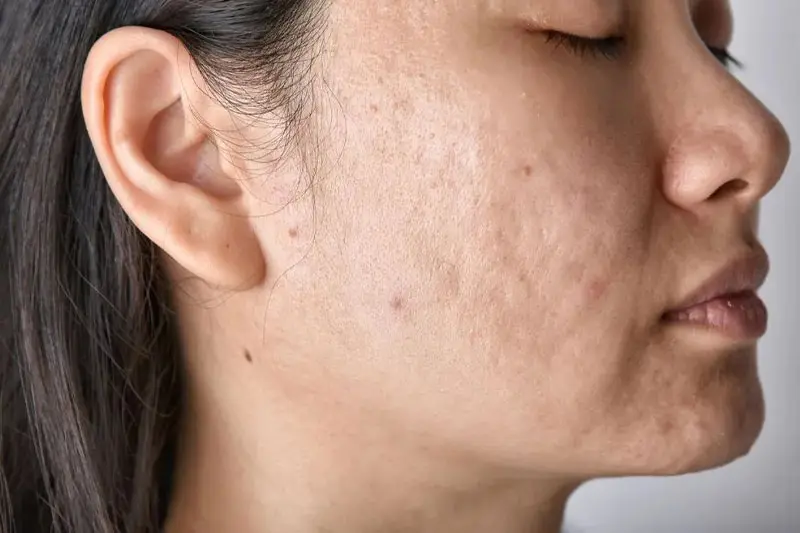 برای درمان اسکار جای جوش لیزر فرکشنال CO2 یا میکرونیدلینگ؟ کدام مناسبتر است؟