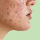 11 نکته برتر برای درمان آکنه در نوجوانان