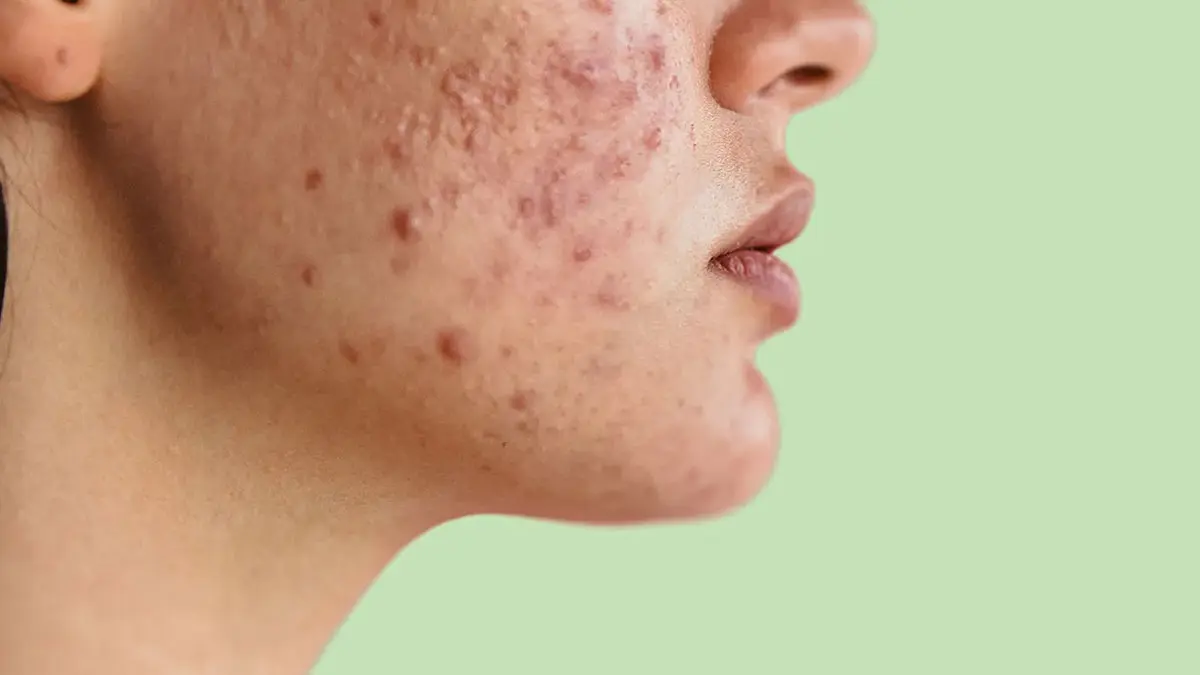 11 نکته برتر برای درمان آکنه در نوجوانان
