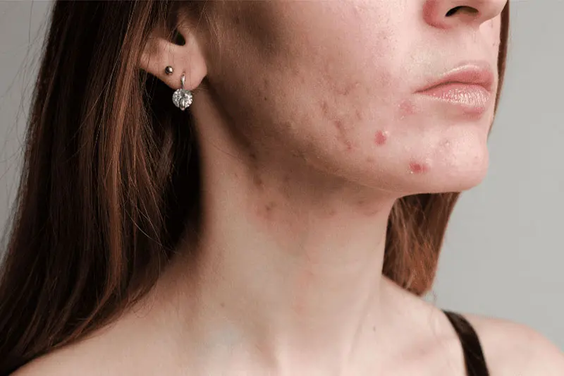 آیا پاپ کورن باعث آکنه میشود؟