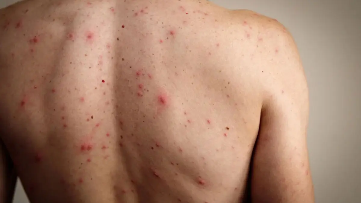 - اسپری ضدجوش 1