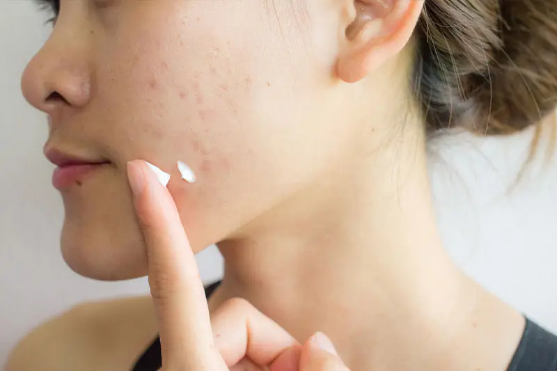 ژل یا کرم بنزوئیل پراکسید (۲.۵ تا ۵ درصد)