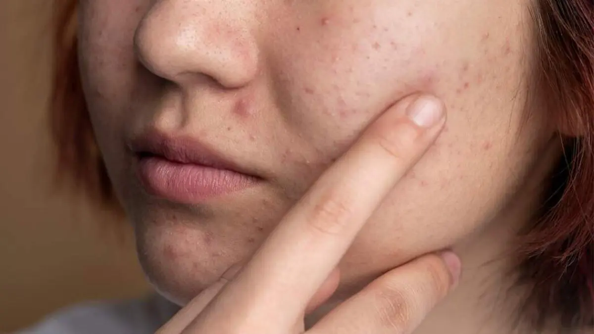 - پوست مستعد آکنه 1