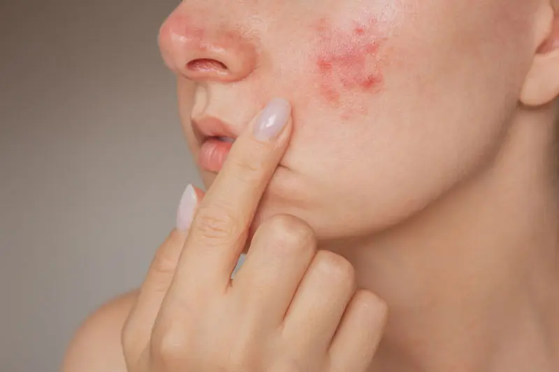 - پوست مستعد آکنه 2