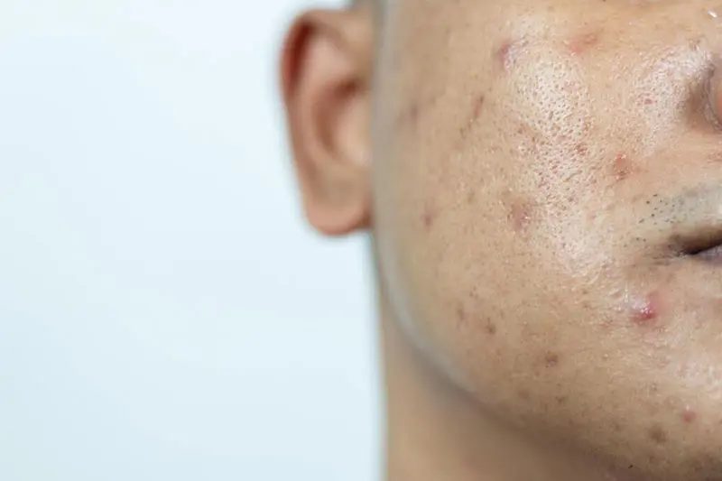 - پوست مستعد آکنه 3