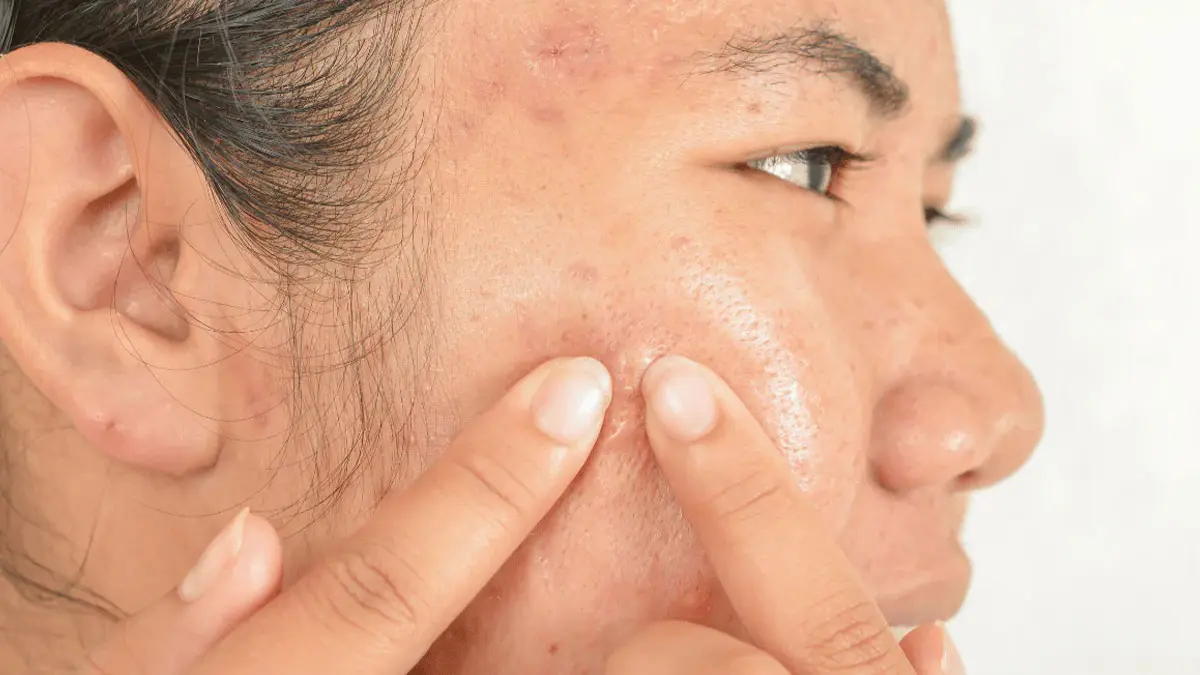 - تخممرغ و آکنه 1