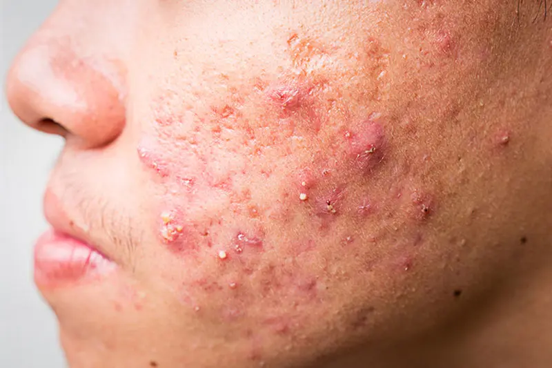 بیوتین چیست و چرا مصرف میشود؟