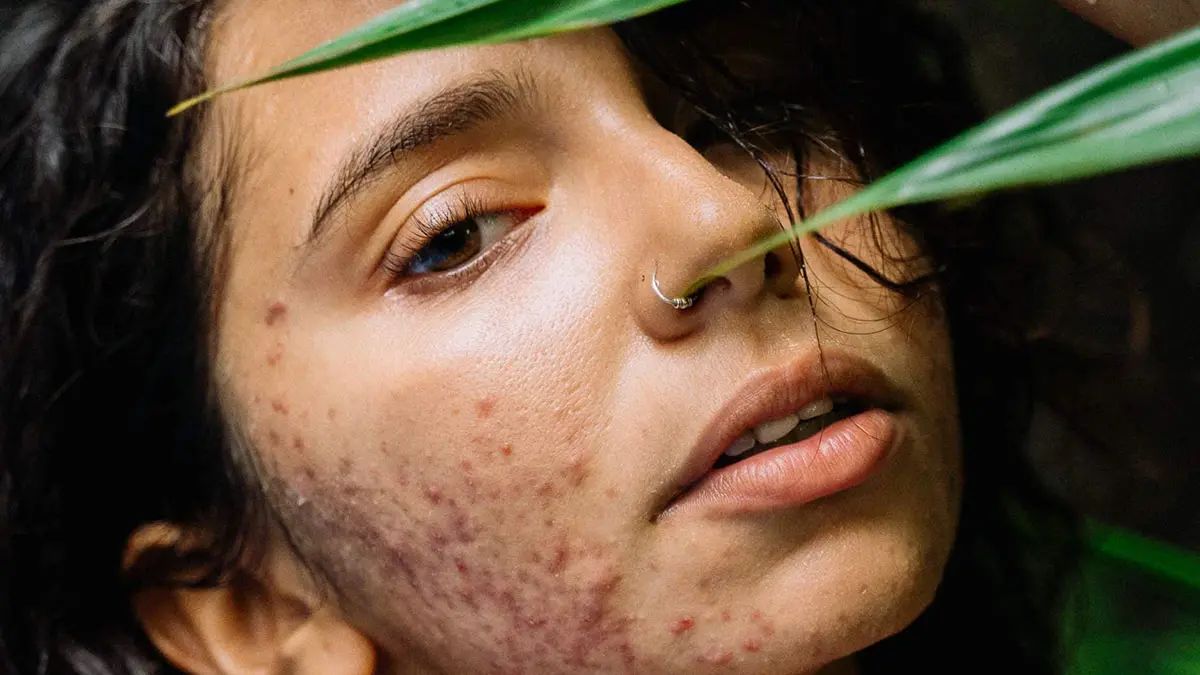 در محصولات ضد جوش به دنبال چه چیزی باشیم؟