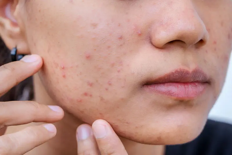 در محصولات ضد جوش از چه چیزهایی دوری کنیم؟