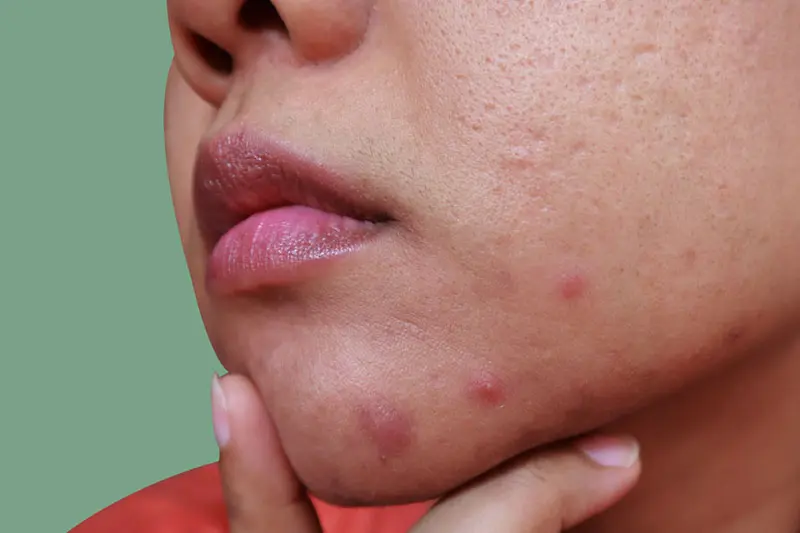 - سندرم تخمدان پلی کیستیک 3