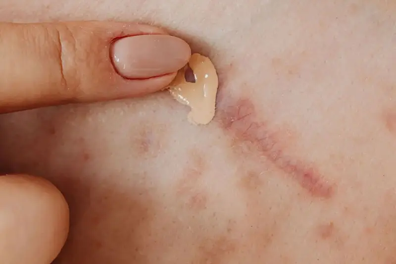 - مخفی کردن جای زخم با میکاپ 2