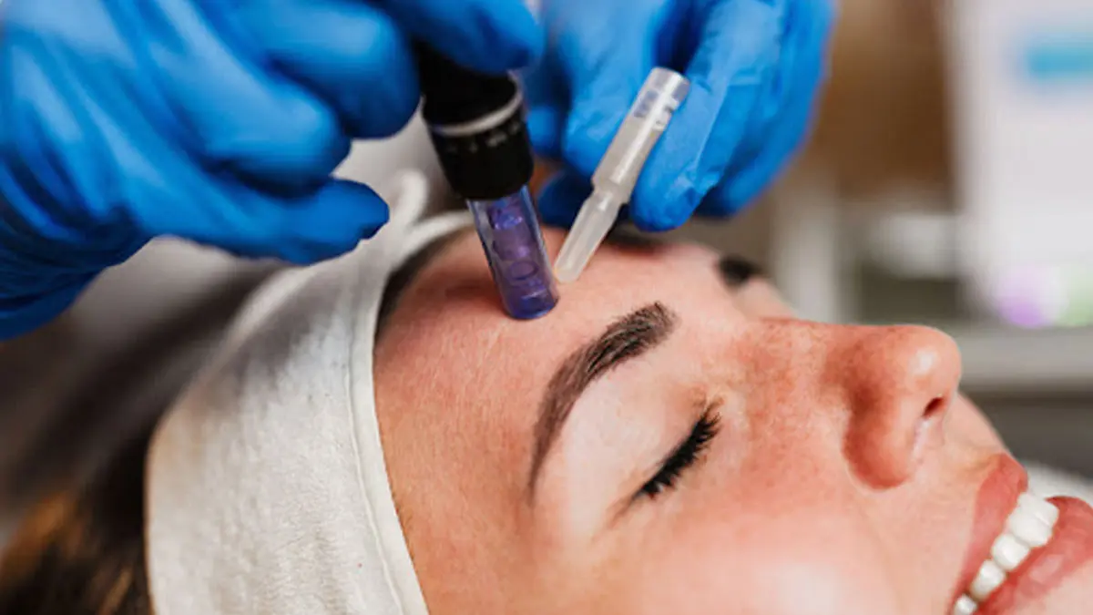 چک لیست خرید بعد از میکرونیدلینگ