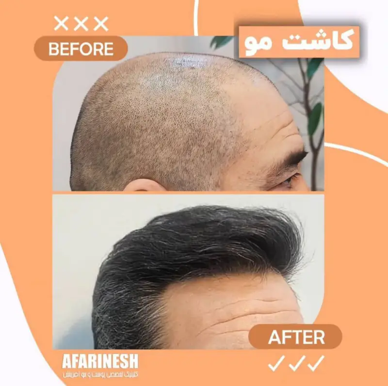 - بهترین کلینیک کاشت مو در مشهد 2