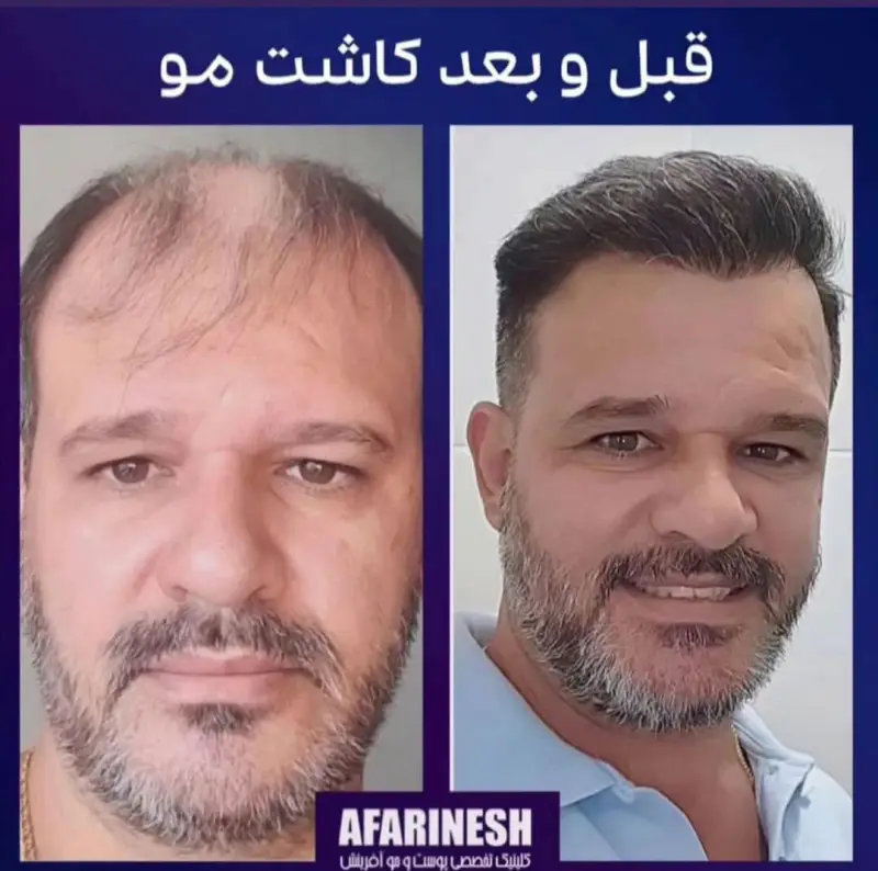 - بهترین کلینیک کاشت مو در مشهد 4