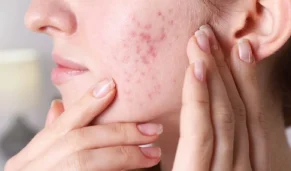 ۱۰ روش ساده و مؤثر برای مدیریت آکنه هورمونی